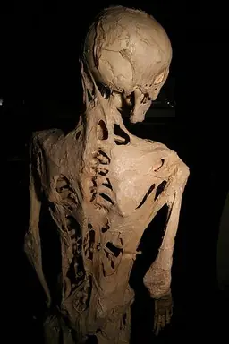 Fibrodysplasia_ossificans_progressiva.png