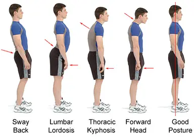 lordosis-treatment-kyphosis-treatment.png