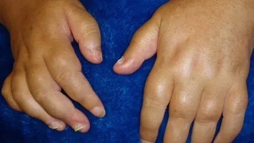 642x361_Gallery_1_10_Symptoms_of_Psoriatic_Arthritis.png